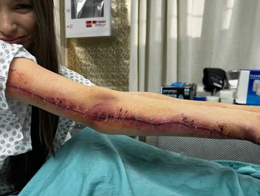 Wound prosthetic on the back of the arm that makes it appear stapled shut