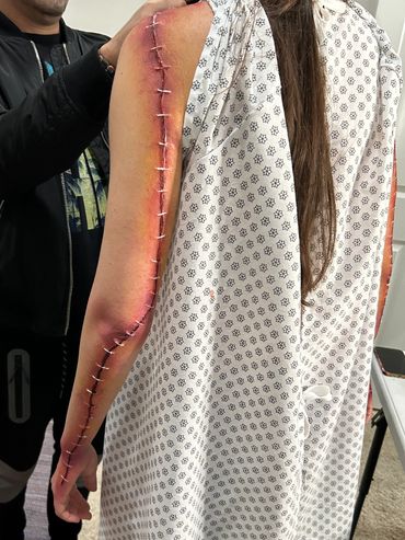 Wound prosthetic on the back of the arm that makes it appear stapled shut