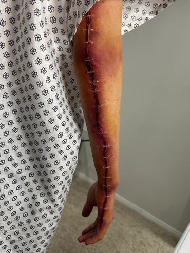Wound prosthetic on the back of the arm that makes it appear stapled shut