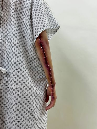 Wound prosthetic on the back of the arm that makes it appear stapled shut