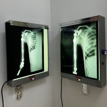 Fake Xray of the surgery and injury that caused the prosthetic wounds.
