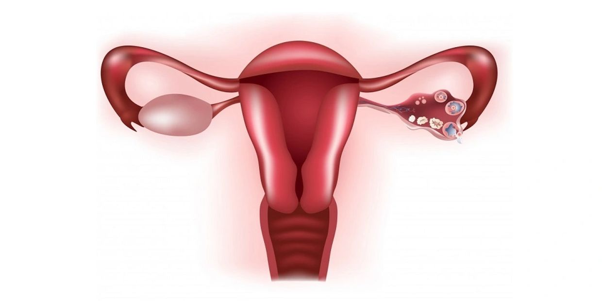 Gynecological problems treatment with Ayurveda