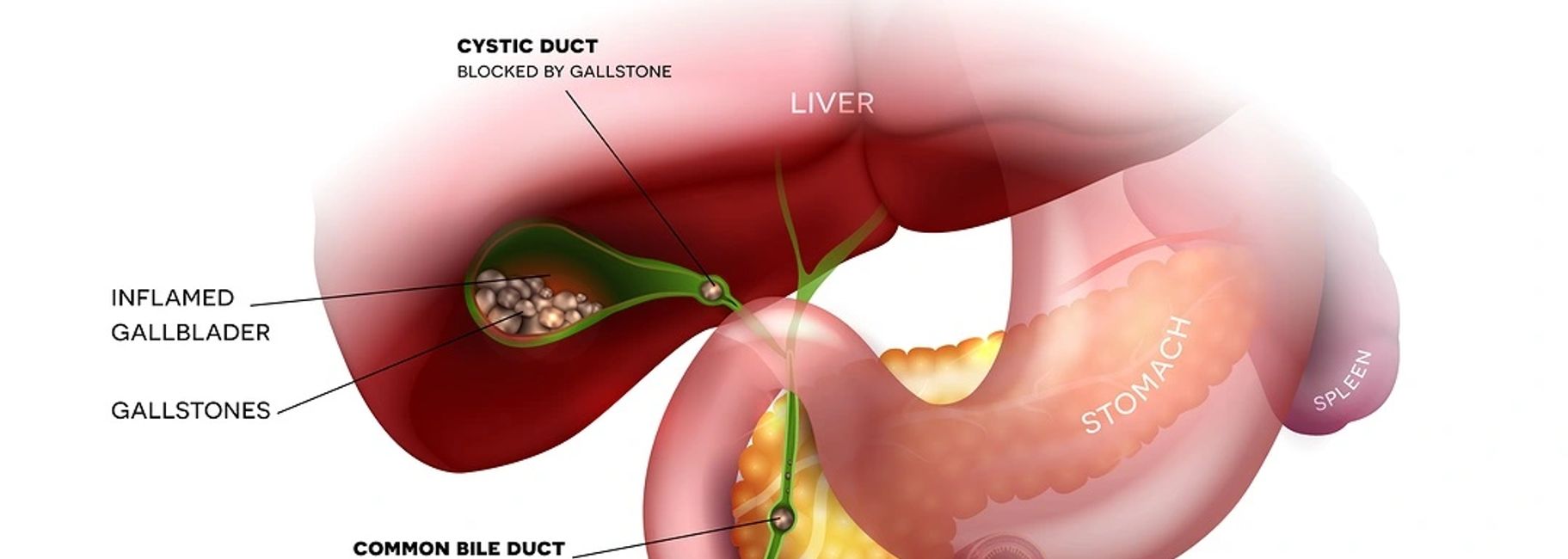 Gall Bladder Stone Vishwanand Ayurved Pune