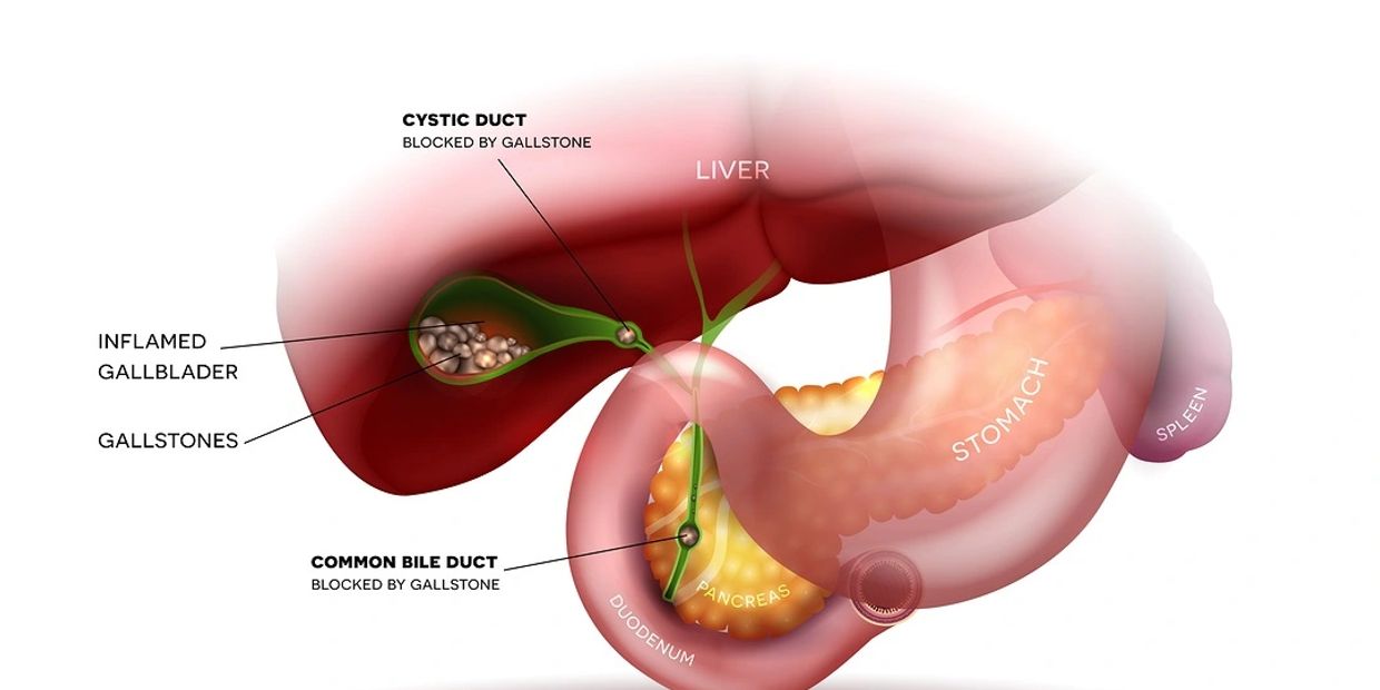 Gall Bladder Stone treatment with Ayurveda