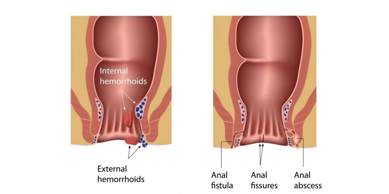 Piles / Fissure / Fistula treatment with Ayurveda