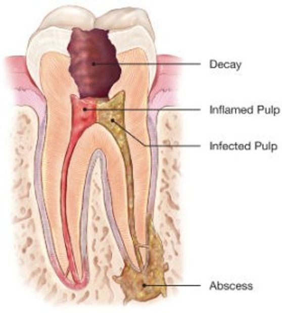 Why an Endodontist?