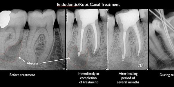 Tampa Bay Endocare - Endodontist, Root Canal Specialists, Endodontics