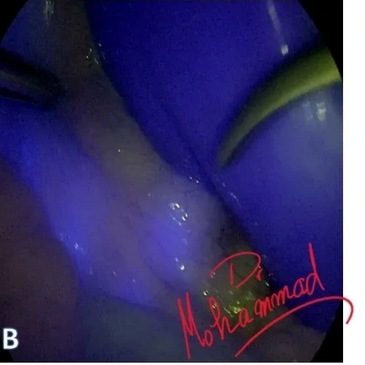 ICG cholecystectomy
استئصال المرارة بالمنظار