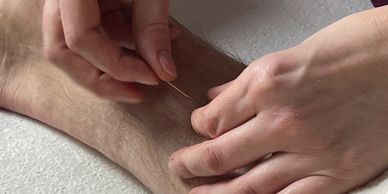 Ankle being needled - acupuncture.