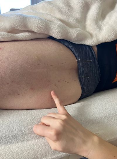 Acupuncture needles inserted around a hip injury in Leamington Spa