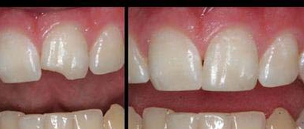 Before and After of a Bonding on a Front Tooth