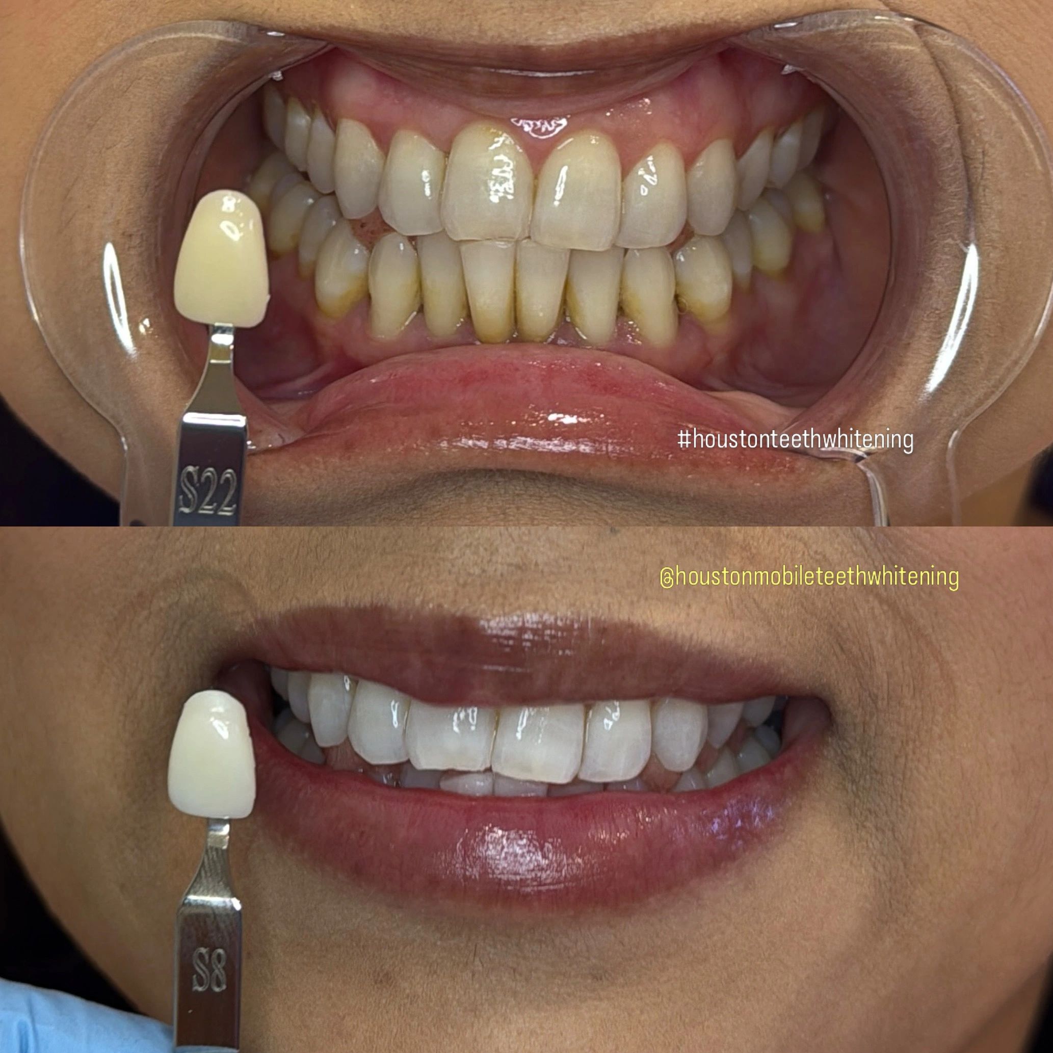 Teeth Whitening Houston