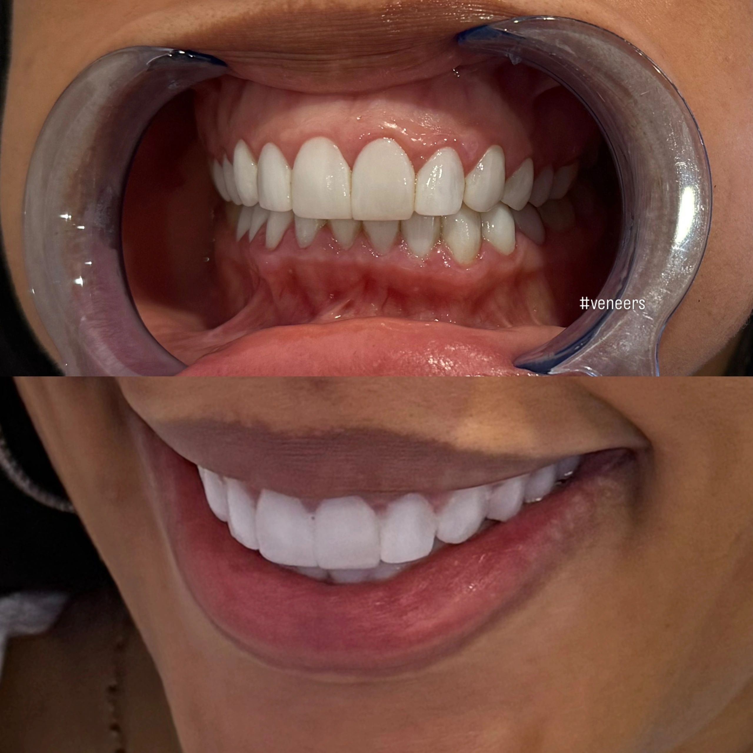 Teeth Whitening Veneers