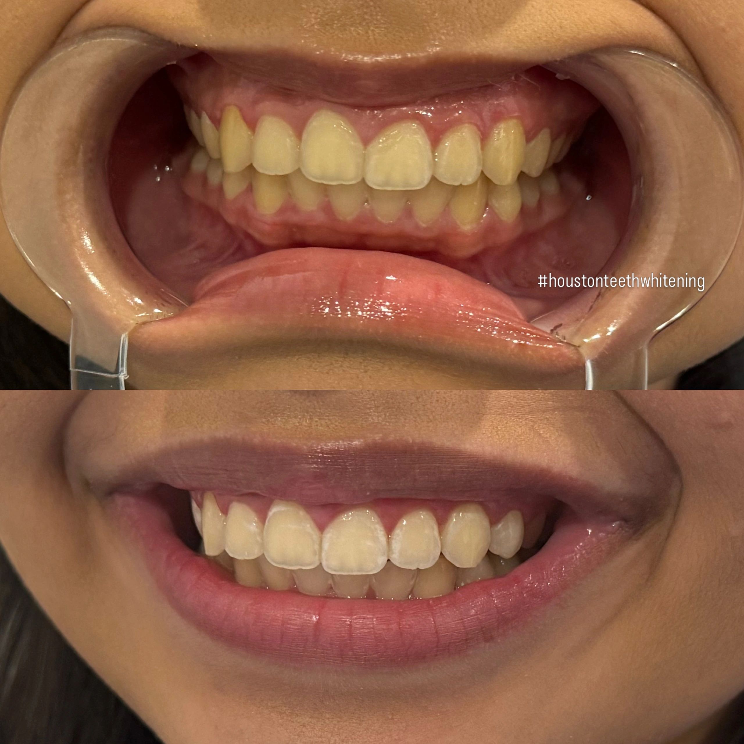 Teeth Whitening Mont Belvieu 