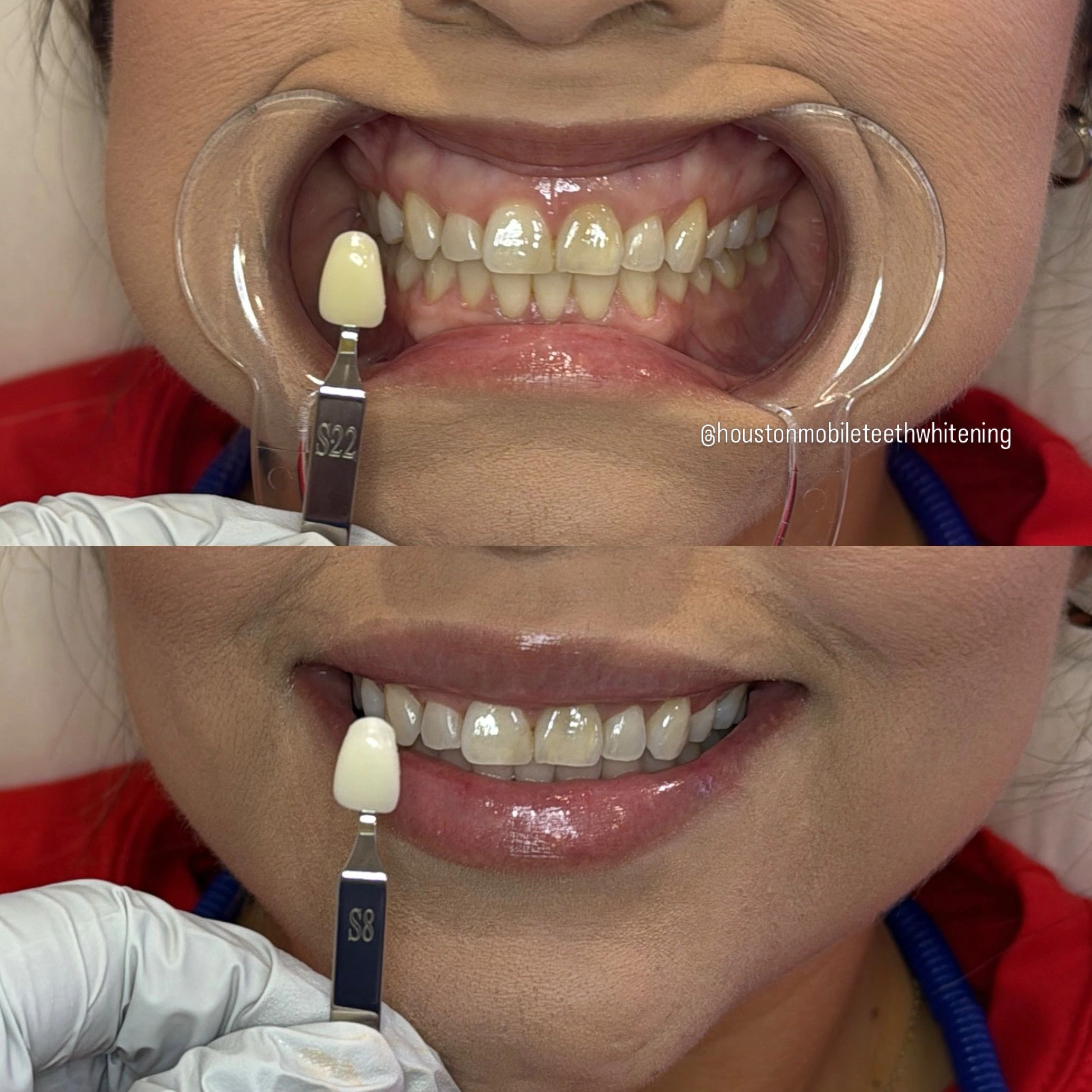 Teeth Whitening Strips