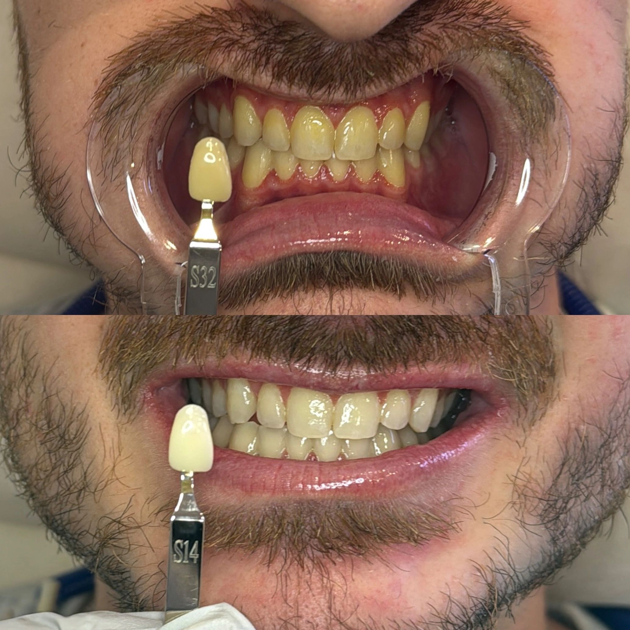 Teeth Whitening Near Me