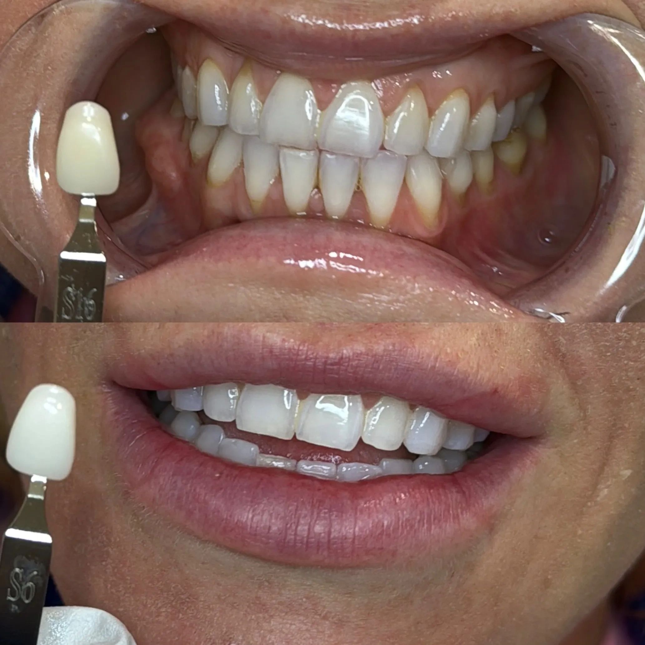 Teeth Whitening Near me