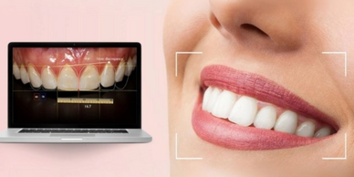 Digital smile design with a laptop and a close-up of a smiling woman's mouth.