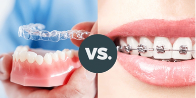 Comparison between clear aligners and traditional braces for teeth straightening.