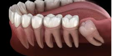 Illustration of impacted wisdom tooth in lower jaw.