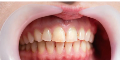 Close-up of a person's teeth with a dental cheek retractor in place.