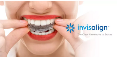 Person inserting a clear Invisalign aligner over teeth with bright red lipstick.