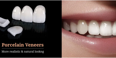 Porcelain veneers offer a natural, realistic look for teeth enhancement.