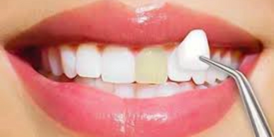 A dental veneer being placed on a discolored tooth.