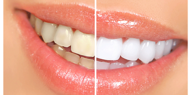 Side-by-side comparison of teeth before and after whitening treatment.