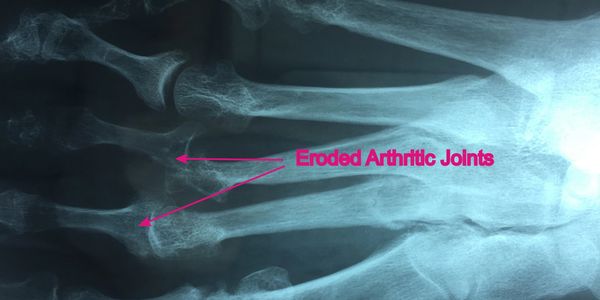 X-Ray showing osteoarthritis of the metatarsophalangeal joints