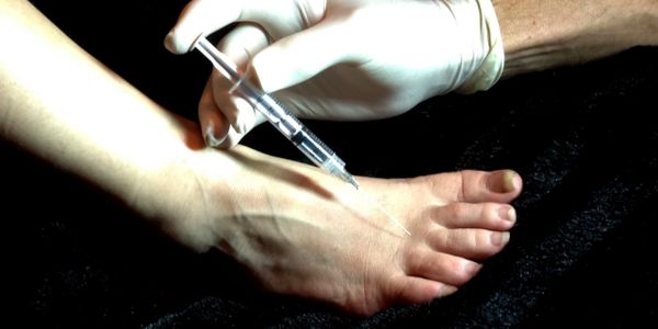 Neuromas are often treated using a steroid injection.