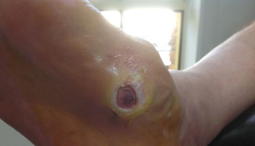 Image of a diabetic foot ulcer.