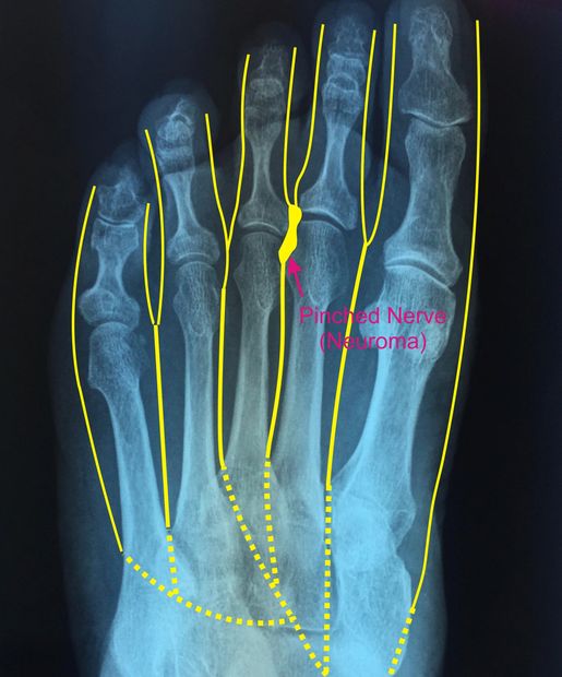 Diagram of the location of a neuroma between the second and third metatarsal bones.