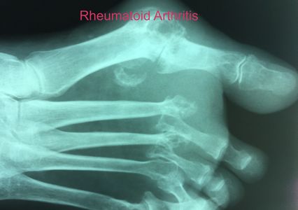 X-Ray showing rheumatoid arthritis of the first metatarsophalangeal joint
