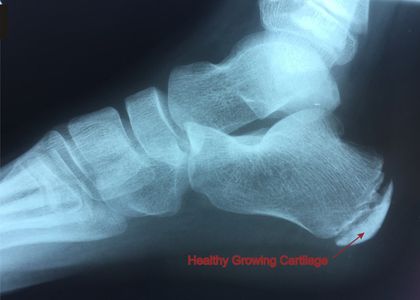 X-Ray of a child's normal growing heel.