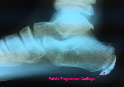 X-Ray of fragmented heel cartilage associated with Severe's disease.
