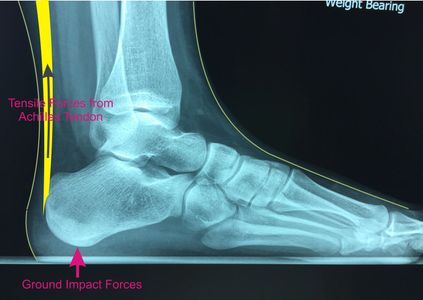 Stresses imposed on the growing heel cartilage of a child.