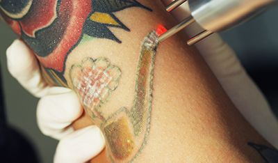 Tattoo Removal Overview