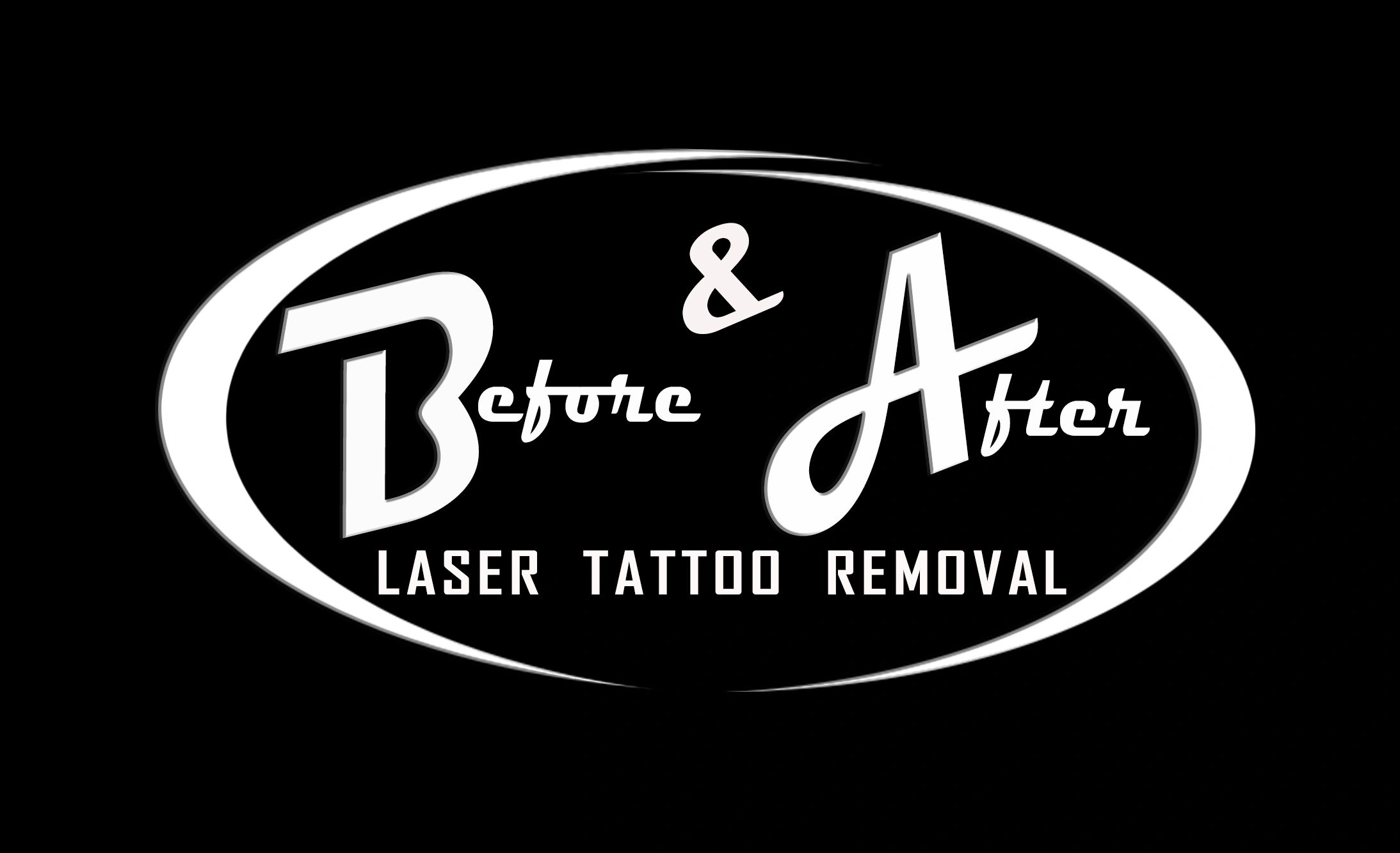 Before & After Laser Tattoo Removal