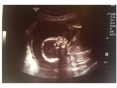 ultrasound image of baby profile