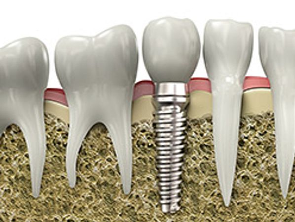 DENTAL IMPLANTS