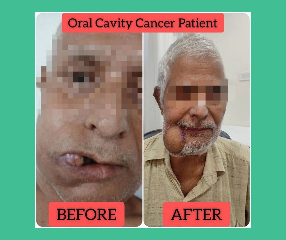 oral cancer surgery