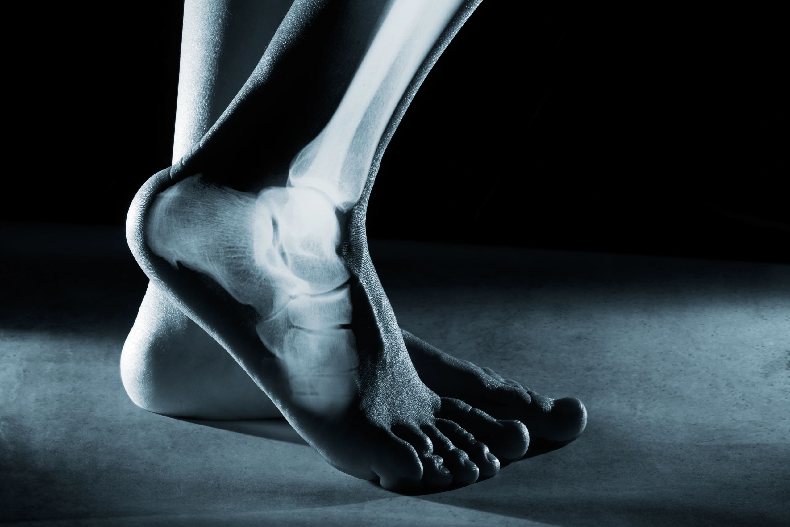 Total ankle Arthroplasty | Sports Foot and Ankle Specialist