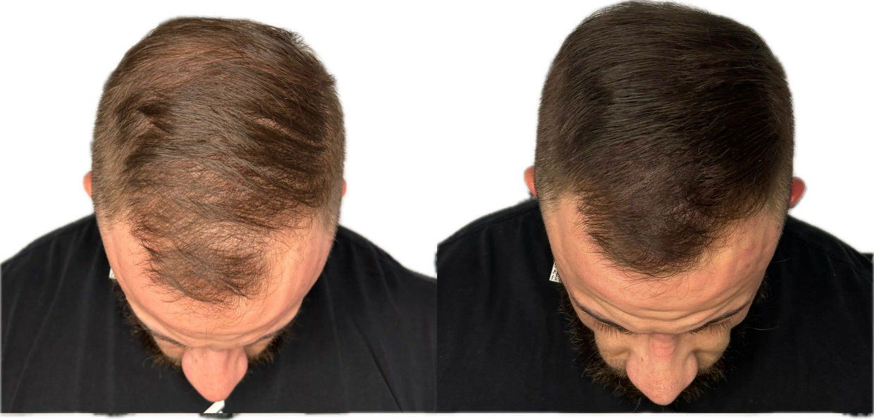 Scalp micropigmentation creates a realistic, thicker-looking scalp you”ll love.  

