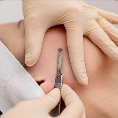 Performing dermaplanning to exfoliate skin and remove fine facial hair. 