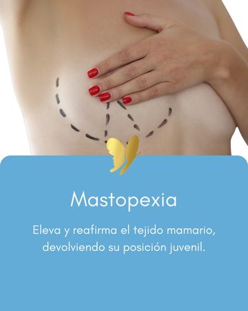 Woman's breast marked for mastopexy surgery, hand covering it.