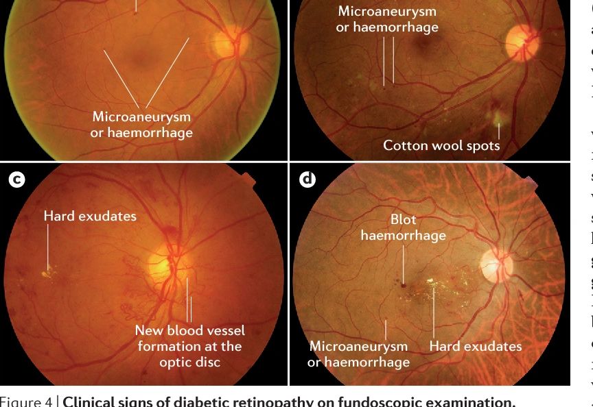 non proliferative diabetic retinopathy