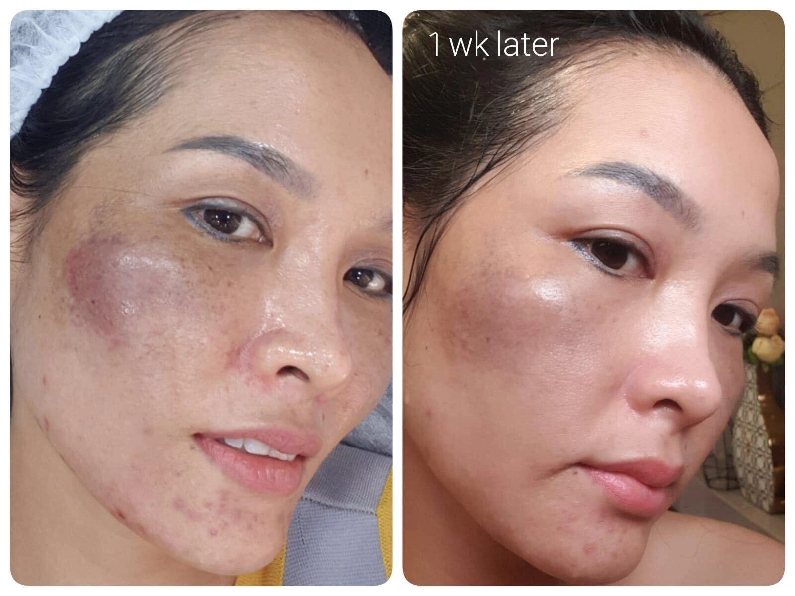 Procell Stem cell Therapy for skin and hair/ Before and After photos