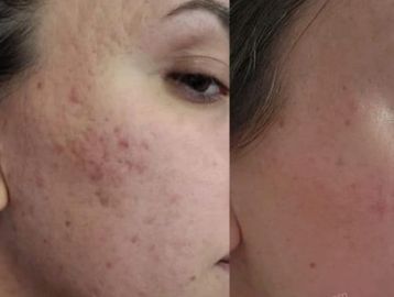 Procell stem cell therapy, microchanneling , microneedling , human stem cell, scars, acne, rosacea, 