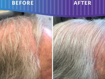 Procell stem cell hair therapy, microchanneling , microneedling , bold, hair loss, age, grey hair, 